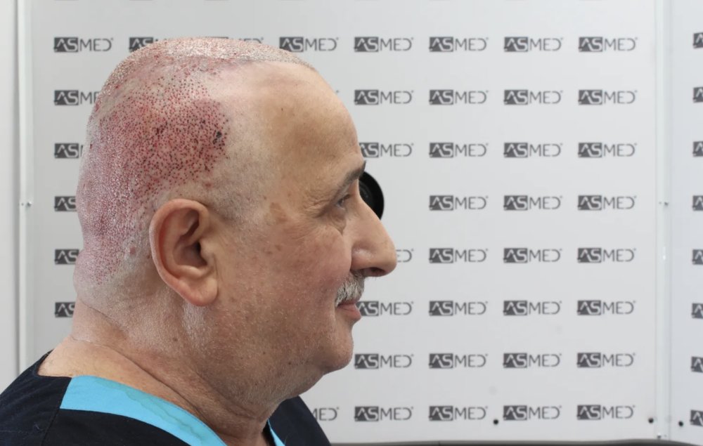 Asmed Clinic - FUE - 4558 Grafts - 12 Month Result. photo