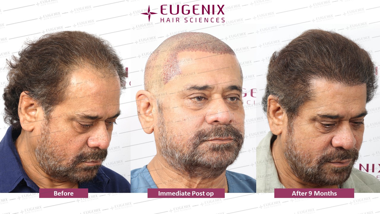 https://cdn.forumhairtransplant.com/original/3X/0/7/07776aaebd6e46ba6df54d25c4afd70be29669e5.jpeg