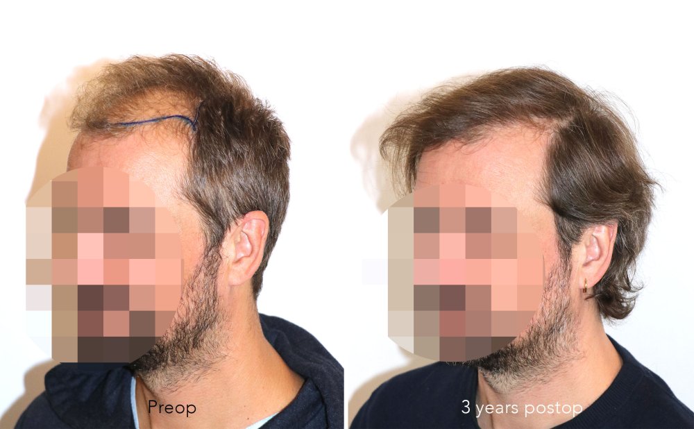 Case performed by Dr. Feriduni – 3378 FU in 1 procedure photo