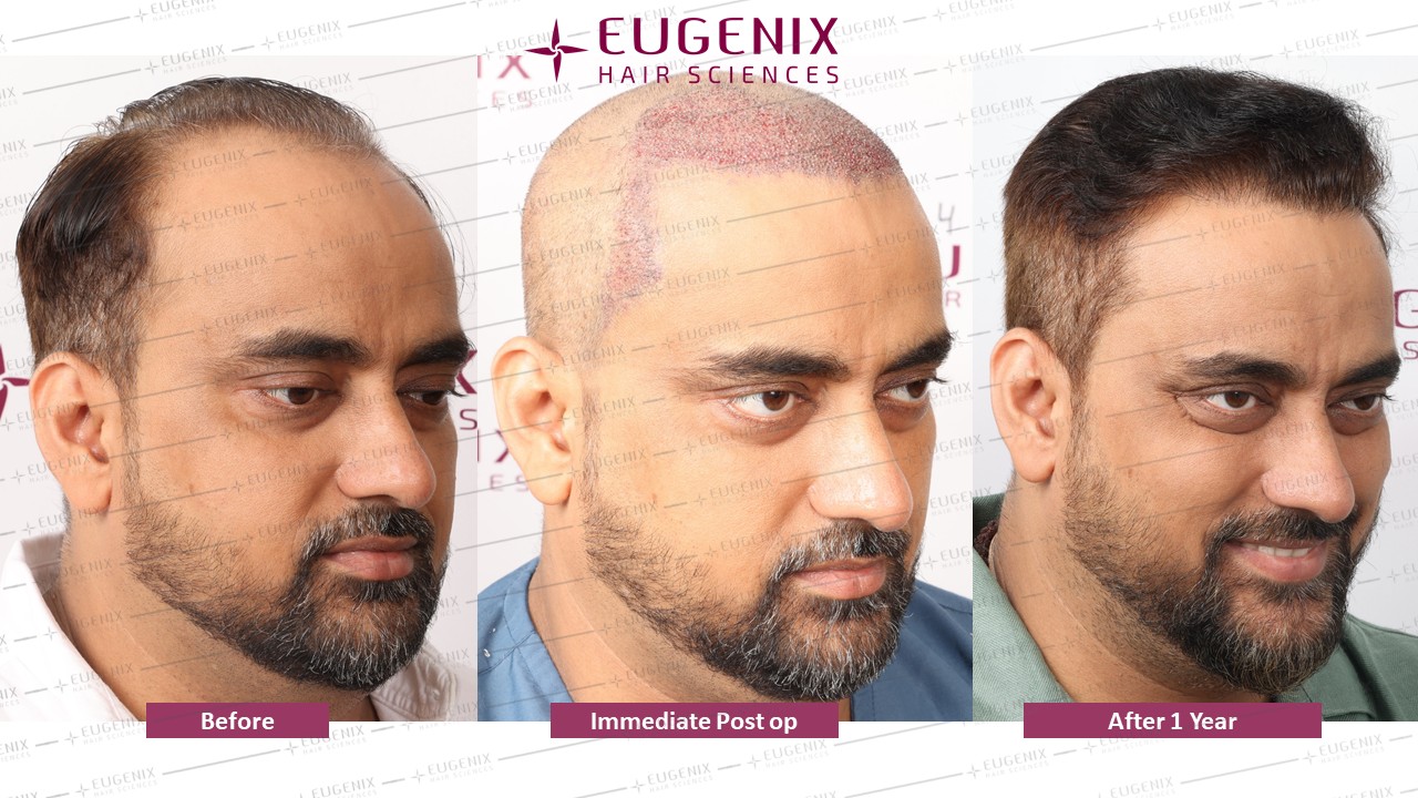 https://cdn.forumhairtransplant.com/original/3X/0/a/0adf55d47cf1d6ca681caaf372a210f877d7a230.jpeg