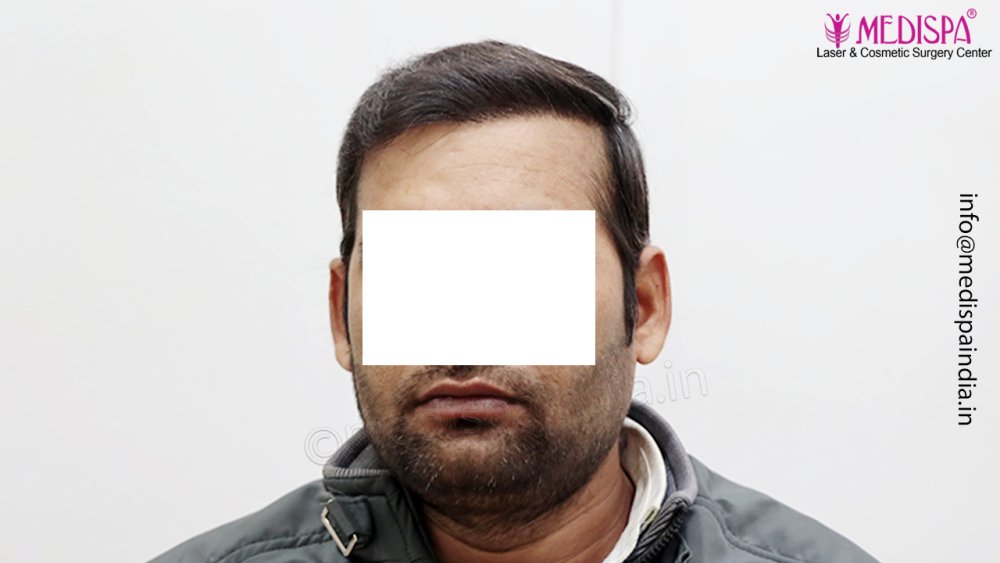 Dr. Suneet Soni - 4992 Grafts | 12-Month Result | Combination FUT + FUE + Beard photo