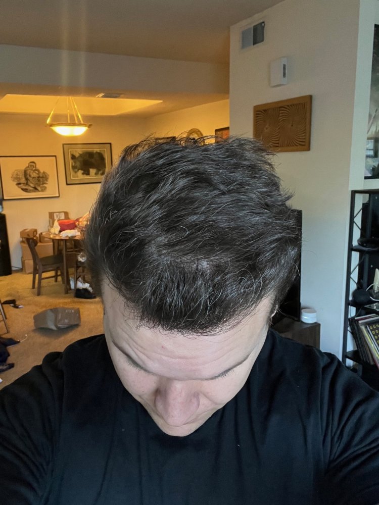 Dr. Ischayek hair restoration result - 1,443 grafts alviarmani photo