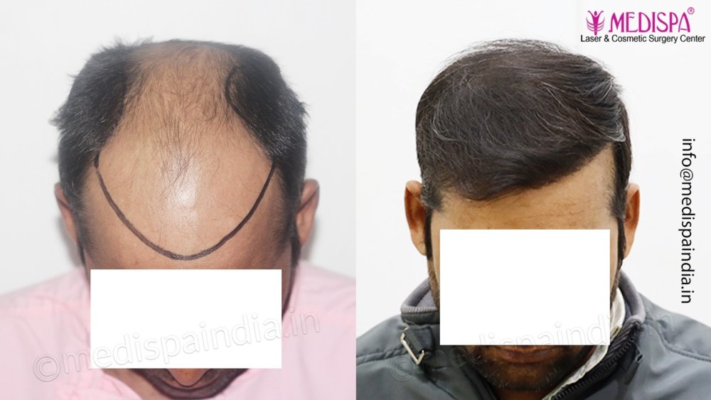 Dr. Suneet Soni - 4992 Grafts | 12-Month Result | Combination FUT + FUE + Beard photo