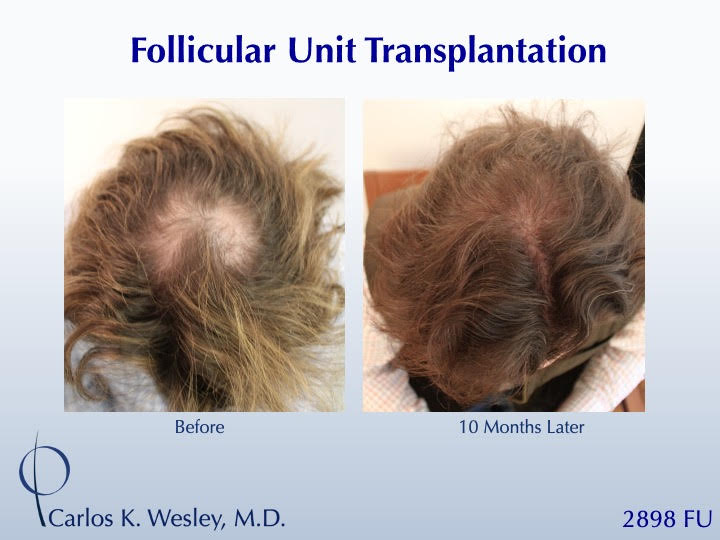 #BAM Hairline and Temples + a Light Crown Coverage (2898 FUT grafts): Carlos K. Wesley, M.D. (NYC & LA) photo
