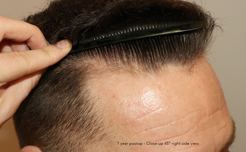 Case performed by Dr. Feriduni – 4008 FU in 1 procedure photo