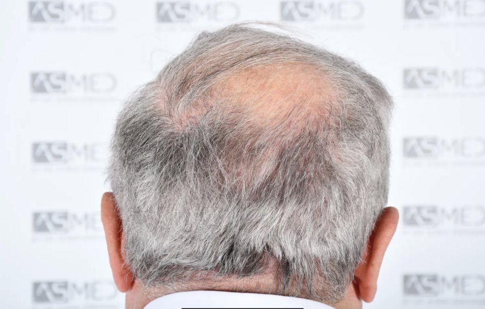 Asmed Clinic - FUE - 4558 Grafts - 12 Month Result. photo