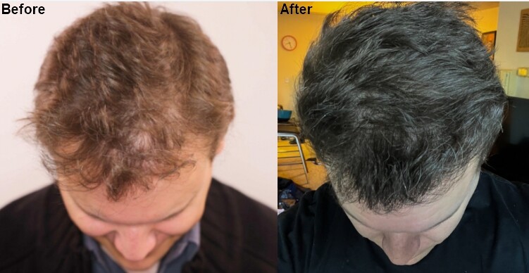Dr. Ischayek hair restoration result - 1,443 grafts alviarmani photo