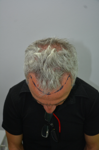 Hair Transplant Results, FUE, 3.000 grafts, Before and After photo