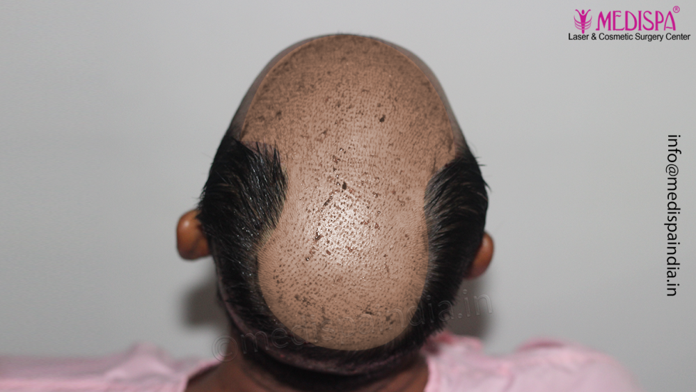 Dr. Suneet Soni - 4992 Grafts | 12-Month Result | Combination FUT + FUE + Beard photo