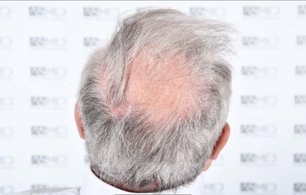Asmed Clinic - FUE - 4558 Grafts - 12 Month Result. photo