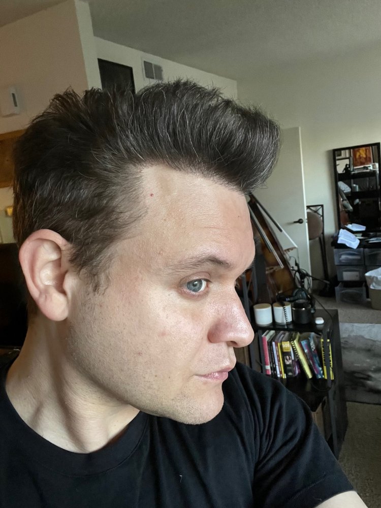 Dr. Ischayek hair restoration result - 1,443 grafts alviarmani photo