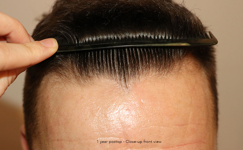 Case performed by Dr. Feriduni – 4008 FU in 1 procedure photo