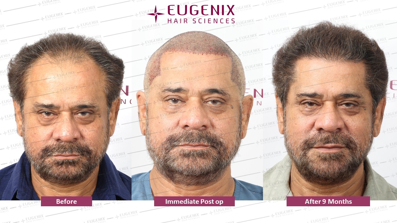 https://cdn.forumhairtransplant.com/original/3X/2/0/2097a922b75d58b7c8cdfe056cec04f353b24142.jpeg