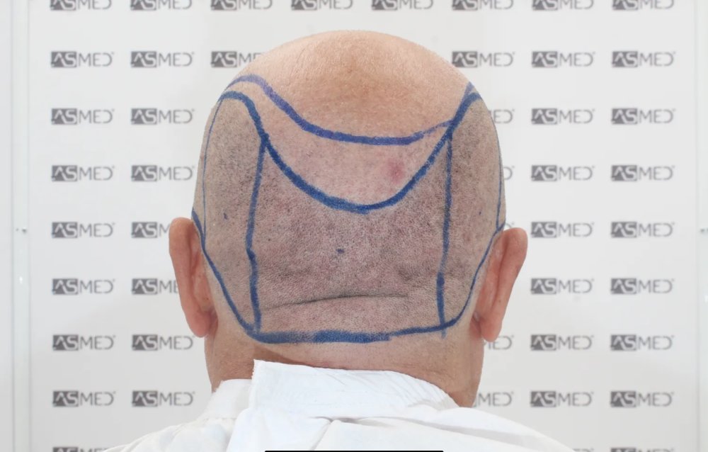 Asmed Clinic - FUE - 4558 Grafts - 12 Month Result. photo