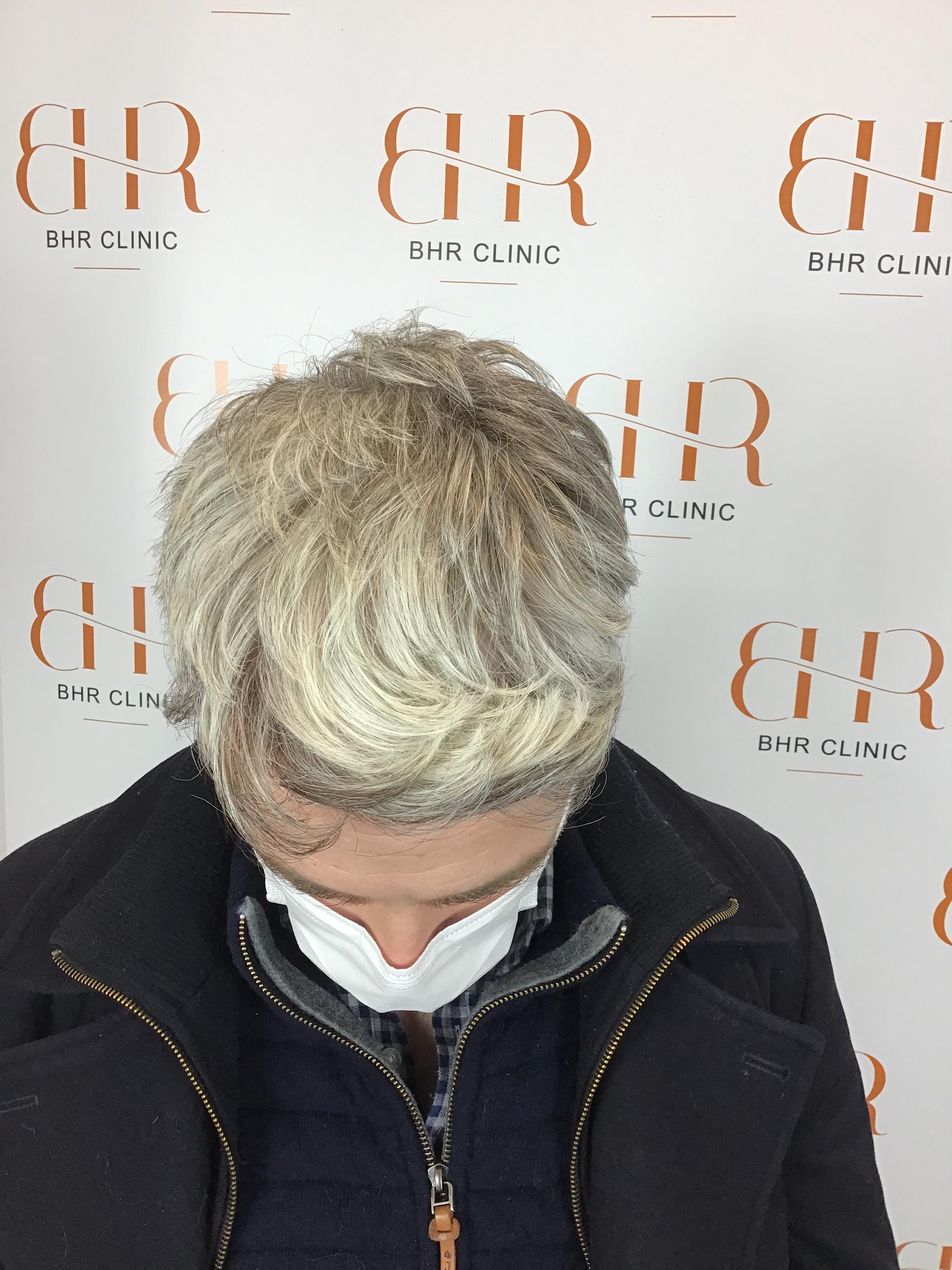 Dr. Bisanga - BHR Clinic - 2180 FUE Repair 0 - 17 Months - Graft Removal and Hairline Reconstruction photo