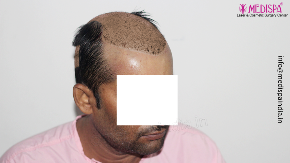 Dr. Suneet Soni - 4992 Grafts | 12-Month Result | Combination FUT + FUE + Beard photo