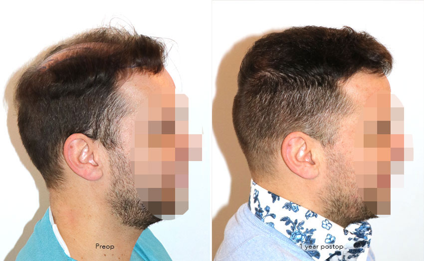 Case performed by Dr. Feriduni – 4008 FU in 1 procedure photo