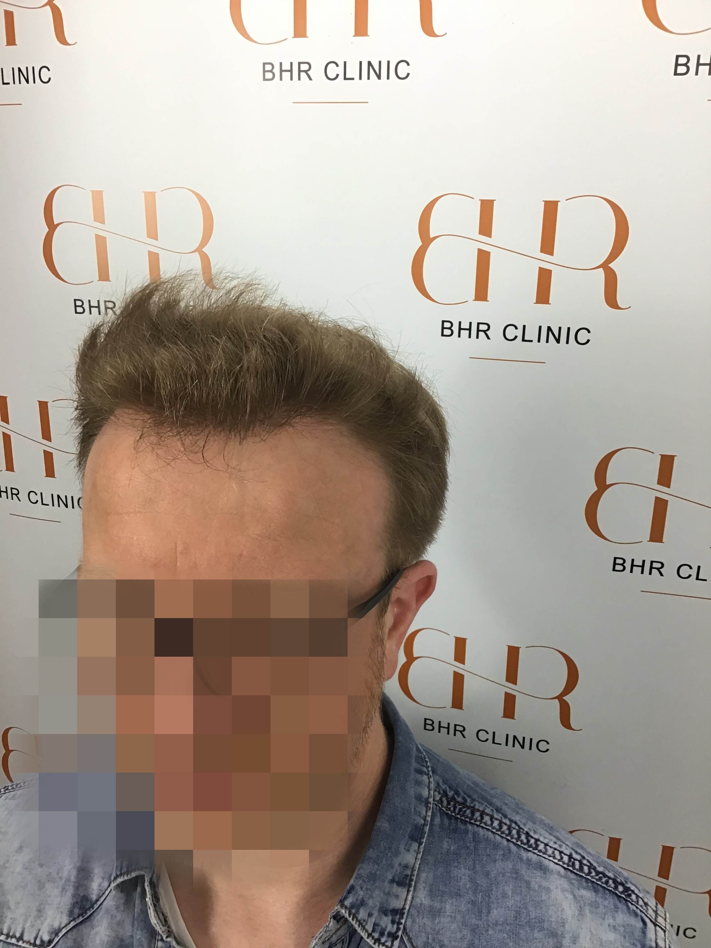 Dr. Bisanga BHR Clinic - 3001 FUE 0 - 15 Months - Fine Blond Hair photo