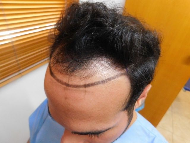 FUE Result for hairline and temples – 1 Year after 2980 grafts – HDC Hair Clinic photo