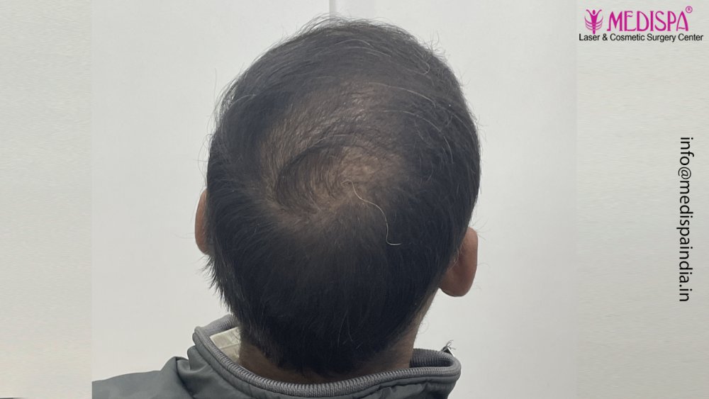 Dr. Suneet Soni - 4992 Grafts | 12-Month Result | Combination FUT + FUE + Beard photo
