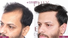 EUGENIX HAIR SCEINCES | GRADE 3A | 1 YEAR 7 MONTHS RESULT photo
