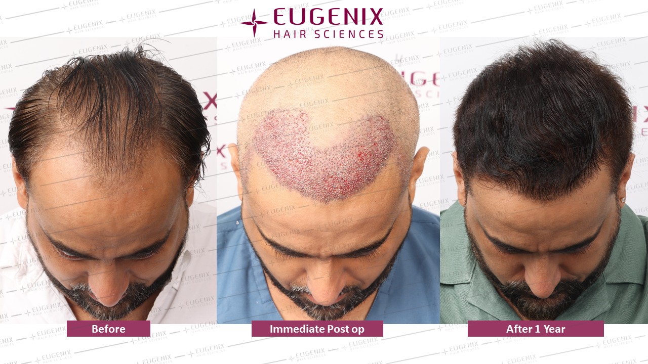 https://cdn.forumhairtransplant.com/original/3X/3/4/34722405d072aa59ff31b190cdc1fef5dfa740ab.jpeg