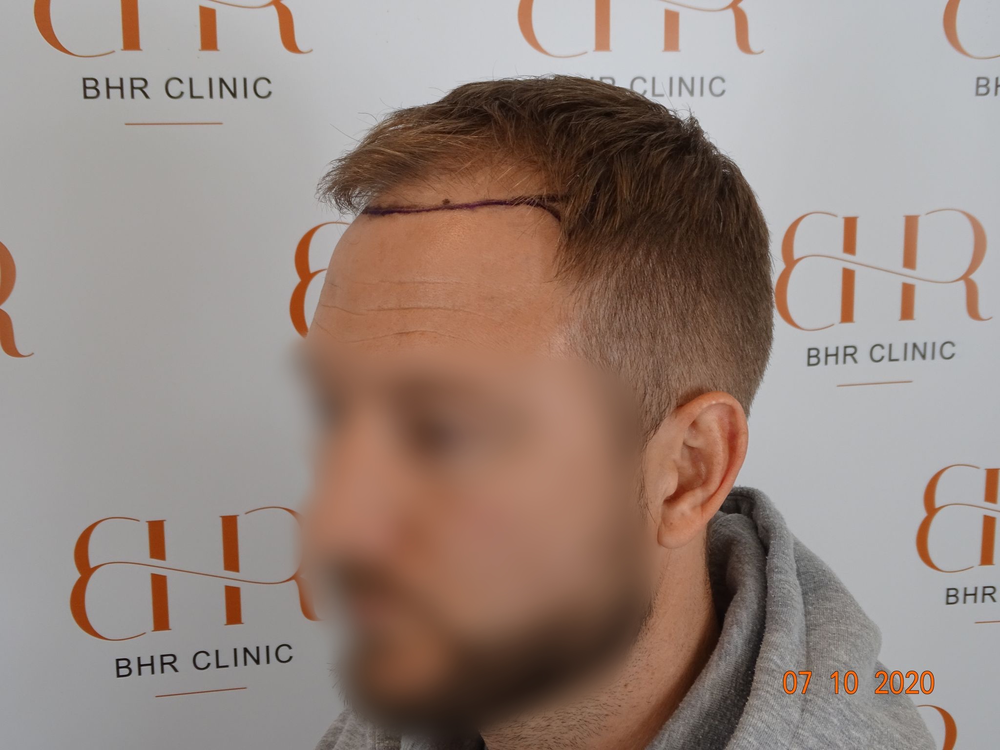 Dr.Bisanga, BHR Clinic Brussels 3251 FUE 0 - 8 Months photo