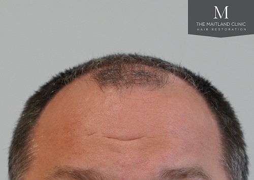 Dr. Edward Ball - The Maitland Clinic FUE Hair Transplant photo