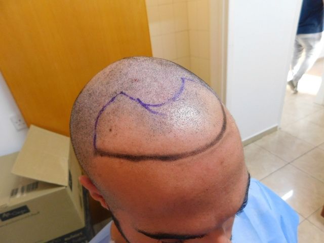 FUE Result for hairline and temples – 1 Year after 2980 grafts – HDC Hair Clinic photo