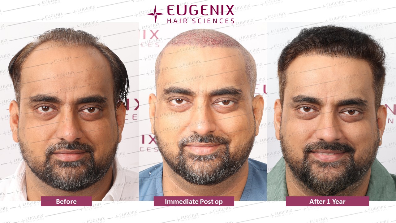 https://cdn.forumhairtransplant.com/original/3X/3/a/3a117b2f6e27a0e37915cfba96a7c0077ab185c4.jpeg