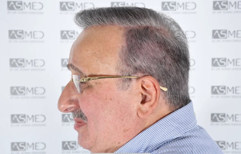 Asmed Clinic - FUE - 4558 Grafts - 12 Month Result. photo