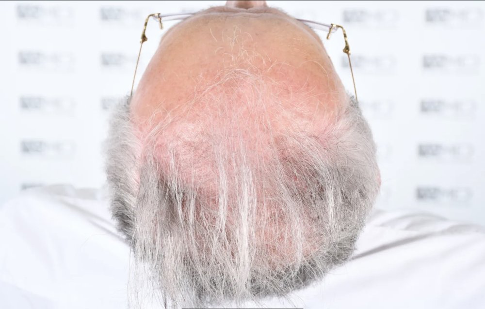 Asmed Clinic - FUE - 4558 Grafts - 12 Month Result. photo