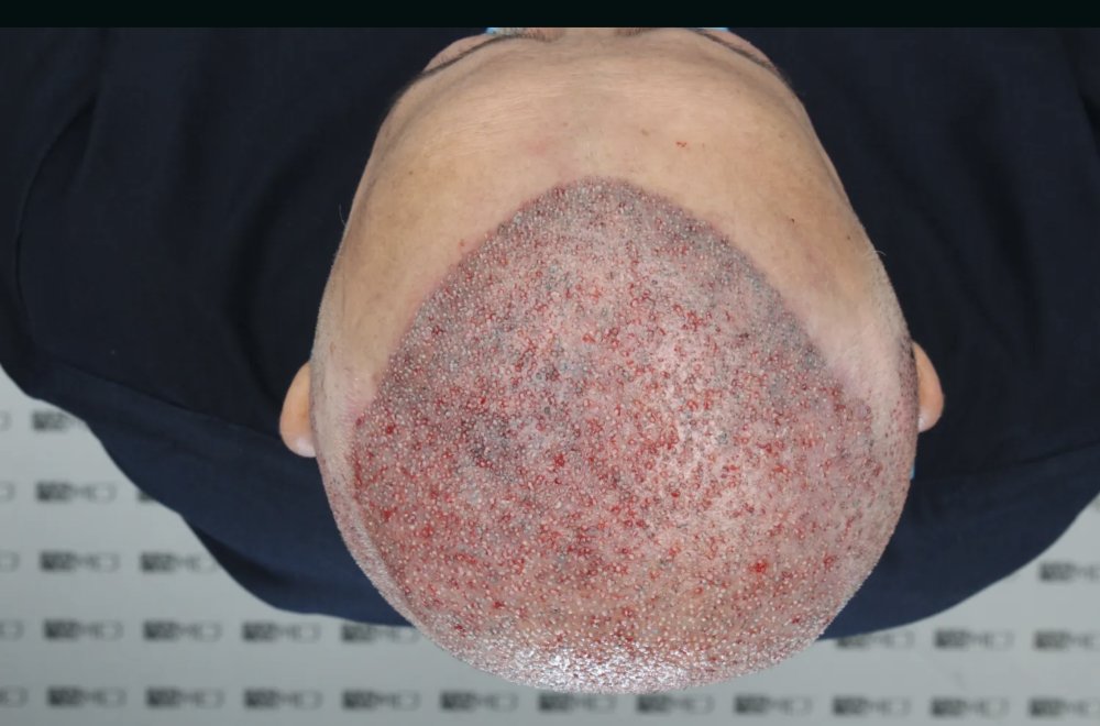Asmed Clinic - FUE - 4558 Grafts - 12 Month Result. photo