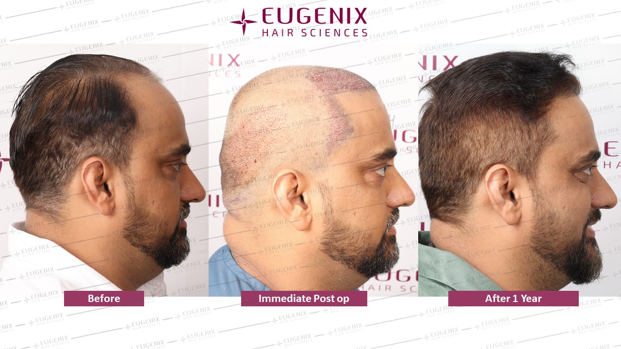 https://cdn.forumhairtransplant.com/original/3X/4/6/46a73965107b143148b9564762c04927f836aa8b.jpeg