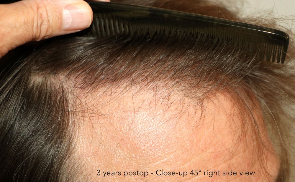 Case performed by Dr. Feriduni – 3378 FU in 1 procedure photo