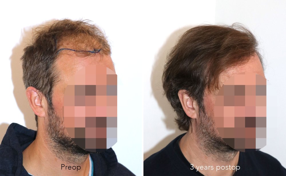 Case performed by Dr. Feriduni – 3378 FU in 1 procedure photo