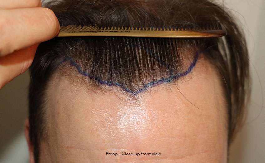 Case performed by Dr. Feriduni – 4008 FU in 1 procedure photo