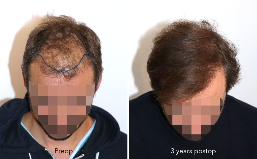 Case performed by Dr. Feriduni – 3378 FU in 1 procedure photo