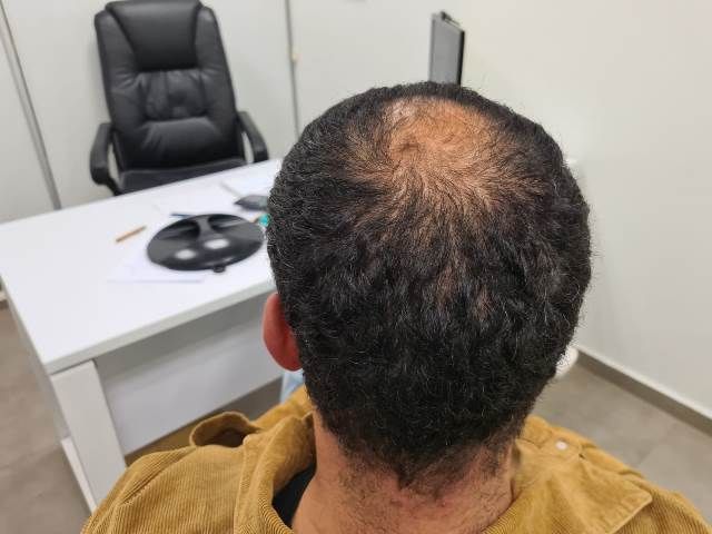 Before and after FUE – Top area coverage 3300 grafts – HDC Hair Clinic – Dr Christina photo