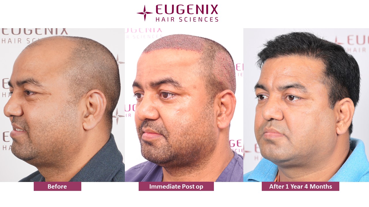 https://cdn.forumhairtransplant.com/original/3X/5/5/5584bf7d8a066504c182be34f6d642a40314141f.jpeg