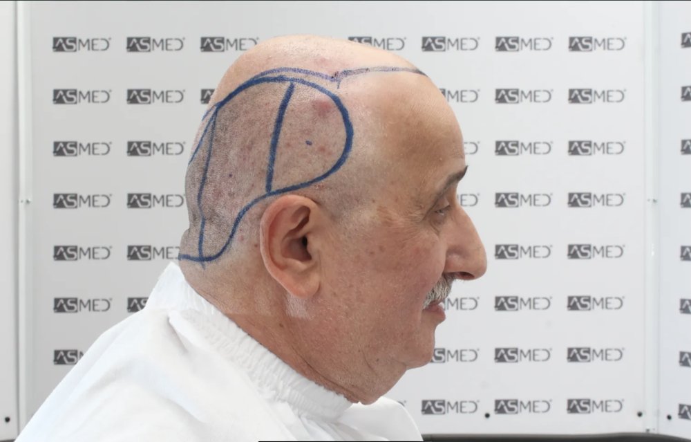 Asmed Clinic - FUE - 4558 Grafts - 12 Month Result. photo