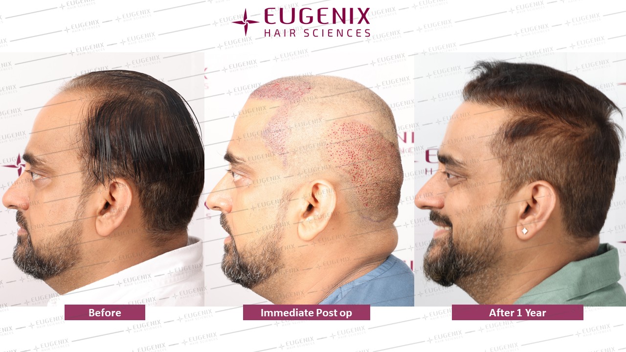 https://cdn.forumhairtransplant.com/original/3X/5/8/58f6b4e6e212f3934719e259cadcf1fa47a41739.jpeg