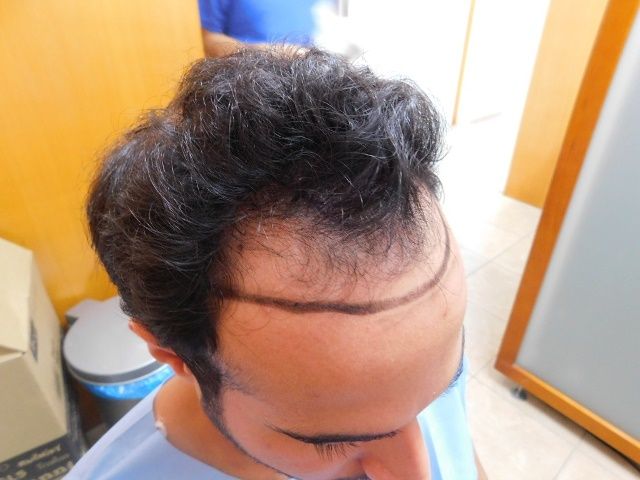 FUE Result for hairline and temples – 1 Year after 2980 grafts – HDC Hair Clinic photo