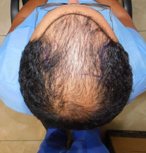 Before and after FUE – Top area coverage 3300 grafts – HDC Hair Clinic – Dr Christina photo