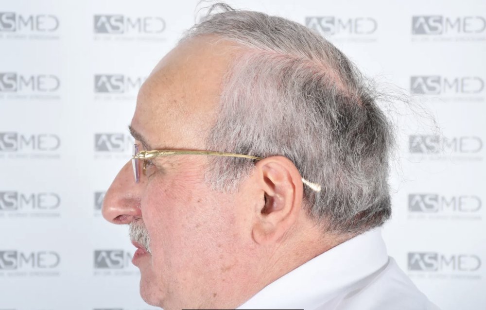 Asmed Clinic - FUE - 4558 Grafts - 12 Month Result. photo