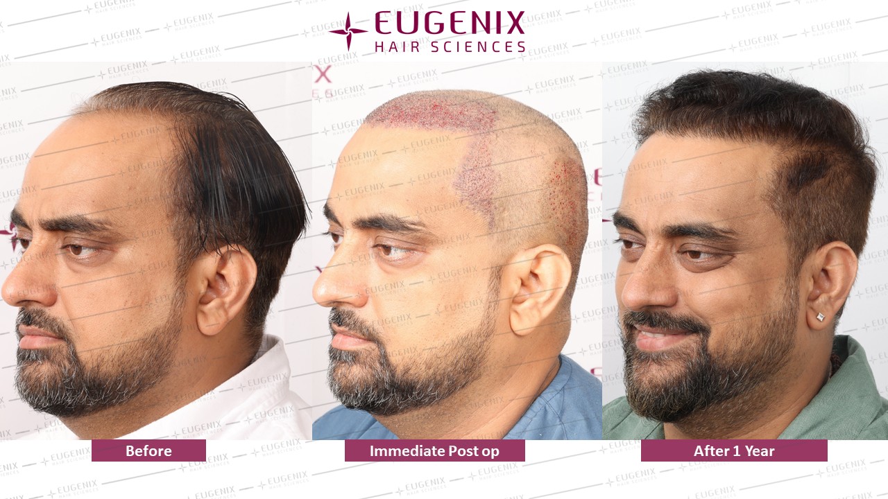 https://cdn.forumhairtransplant.com/original/3X/6/0/60a60a4b0d2f1df60c0cc407ba512b77772145de.jpeg