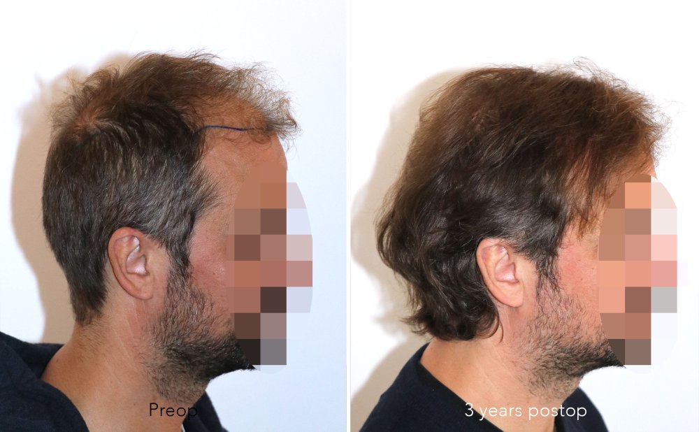 Case performed by Dr. Feriduni – 3378 FU in 1 procedure photo