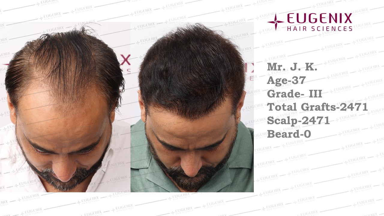 https://cdn.forumhairtransplant.com/original/3X/6/9/69bb35aefa22fd5d219de93dfe986916aa09d811.jpeg