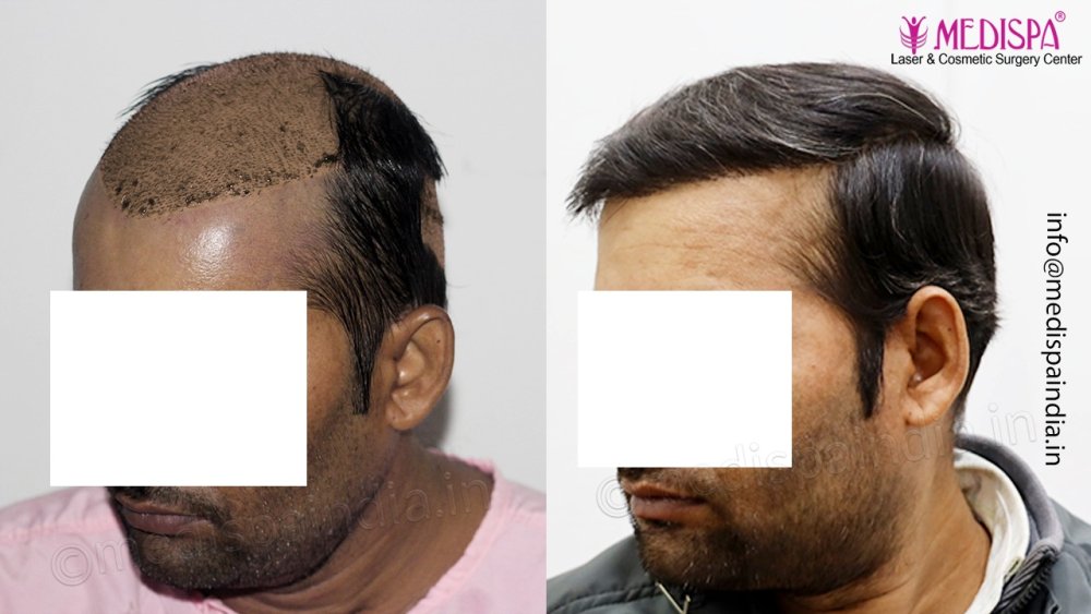 Dr. Suneet Soni - 4992 Grafts | 12-Month Result | Combination FUT + FUE + Beard photo