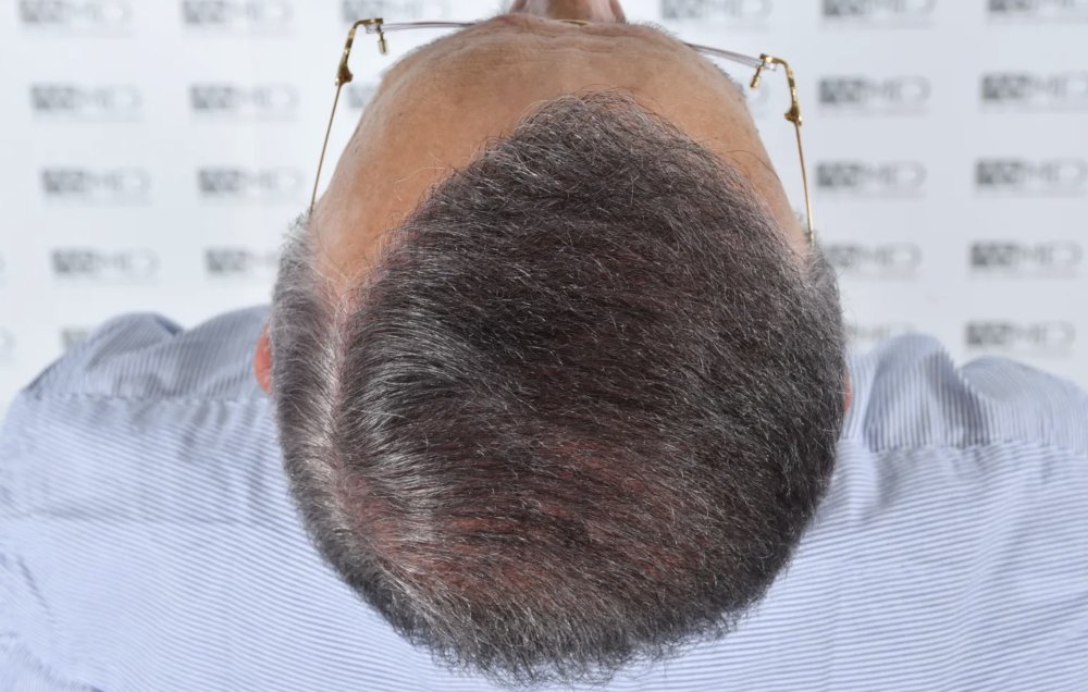 Asmed Clinic - FUE - 4558 Grafts - 12 Month Result. photo
